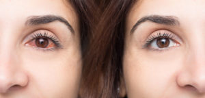 Woman with red eye before and after